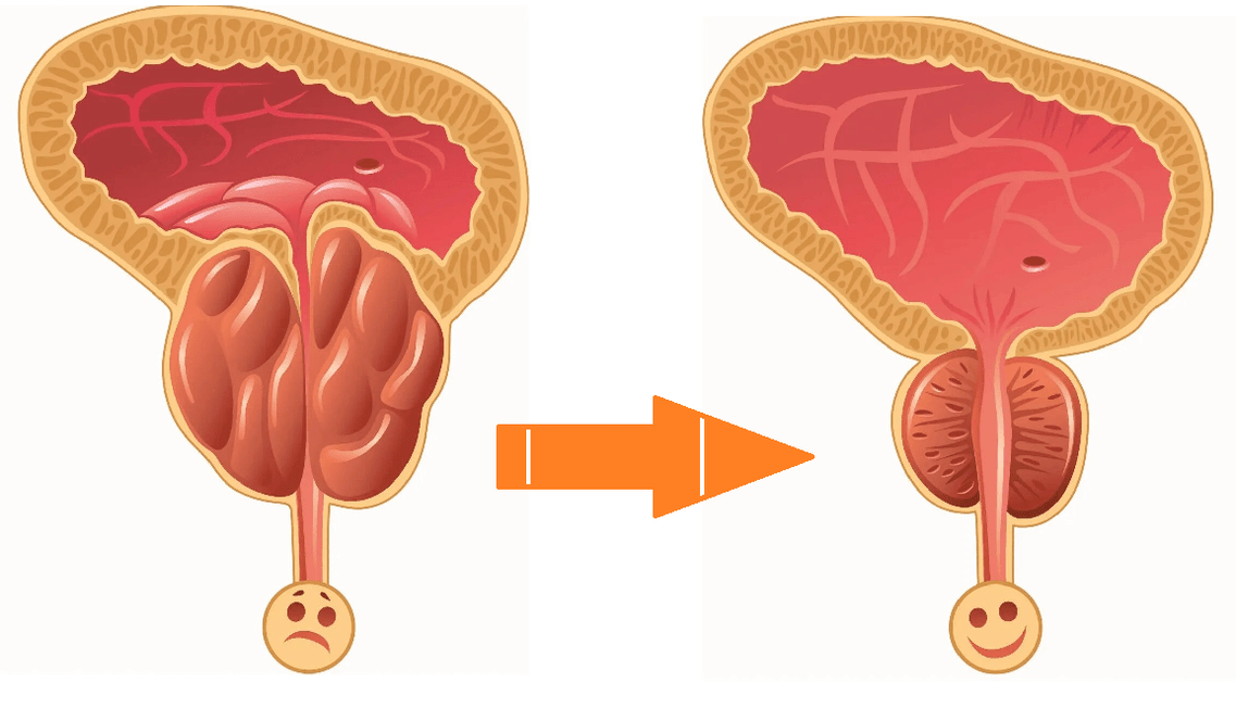 Uromexil Forte UPRAVLJANJE NA PROSTATI S PROSTATITITIJI IN ADENOMA