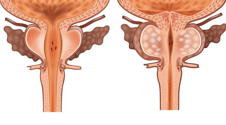 primerjava zdravega in vnetega adenoma