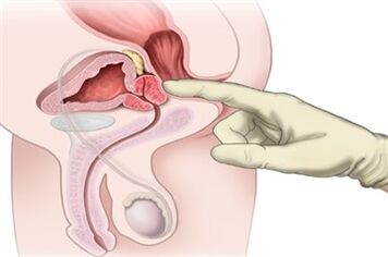 Masaža prostate za zdravljenje kroničnega prostatitisa
