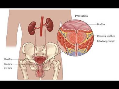 Prostatitis – vnetje prostate