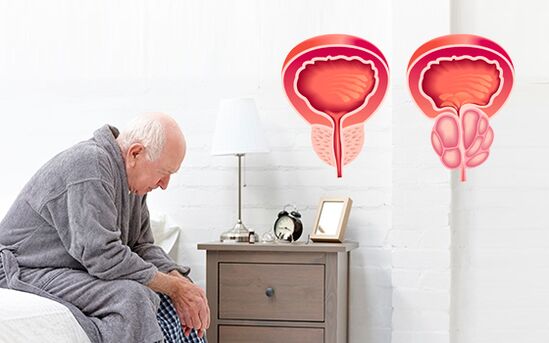 prostatitis pri moških